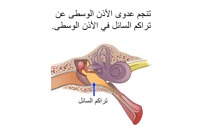 تنجم عدوى الأذن الوسطى عن تراكم السائل في الأذن الوسطى.