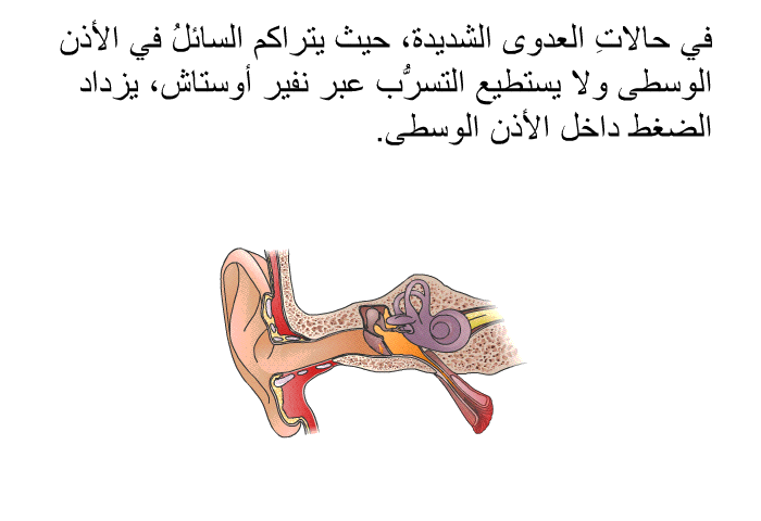 في حالاتِ العدوى الشديدة، حيث يتراكم السائلُ في الأذن الوسطى ولا يستطيع التسرُّب عبر نفير أوستاش، يزداد الضغط داخل الأذن الوسطى.