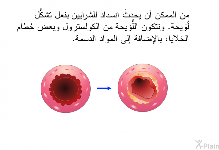 من الممكن أن يحدثَ انسداد للشريان بفعل تشكُّل لُوَيحة. وتتكون اللُّوَيحة من الكولسترول وبعض حُطام الخلايا، بالإضافة إلى المواد الدسمة.