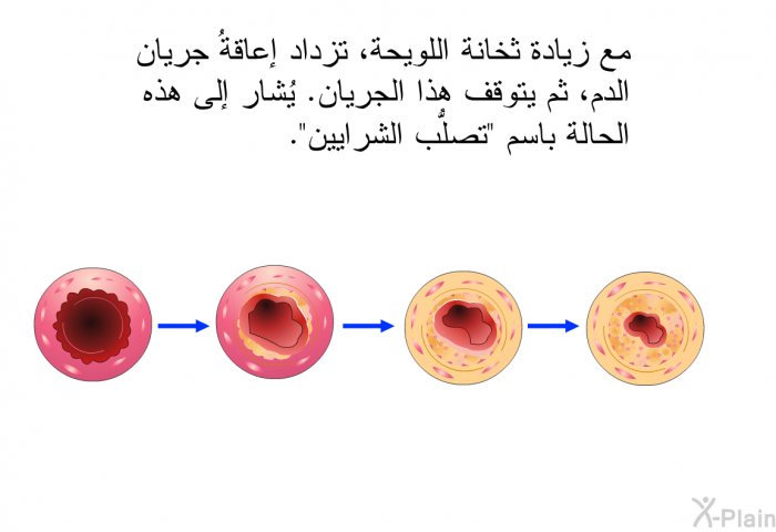 مع زيادة ثخانة اللويحة، تزداد إعاقةُ جريان الدم، ثم يتوقف هذا الجريان. يُشار إلى هذه الحالة باسم "تصلُّب الشرايين".