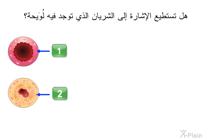 هل تستطيع الإشارة إلى الشريان الذي توجد فيه لُوَيحة؟.