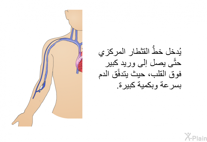 يُدخل خطُّ القثطار المركزي حتَّى يصل إلى وريد كبير فوق القلب، حيث يتدفَّق الدم بسرعة وبكمية كبيرة.
