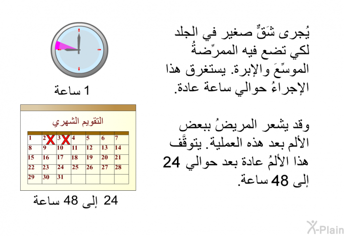 يُجرى شَقٌّ صغير في الجلد لكي تضع فيه الممرِّضةُ الموسِّعَ والإبرة. يستغرق هذا الإجراءُ حوالي ساعة عادة. وقد يشعر المريضُ ببعض الألم بعد هذه العملية. يتوقَّف هذا الألمُ عادة بعد حوالي 24 إلى 48 ساعة.