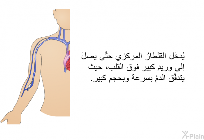 يُدخَل القثطارُ المركزي حتَّى يصلَ إلى وريدٍ كبير فوق القلب، حيث يتدفَّق الدمُ بسرعة وبحجم كبير.