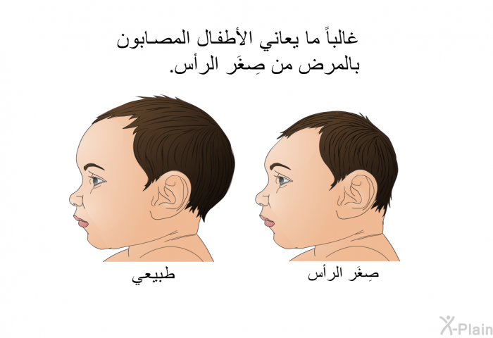 غالباً ما يعاني الأطفال المصابون بالمرض من صِغَر الرأس.