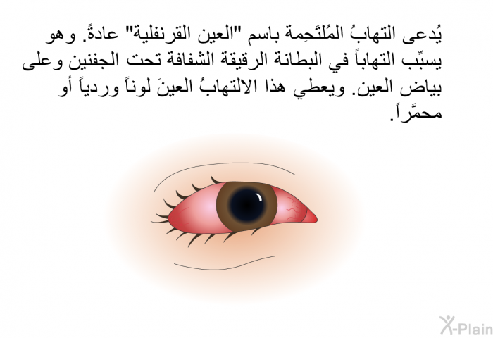 يُدعى التهابُ المُلتَحِمة باسم "العين القرنفلية" عادةً. وهو يسبِّب التهاباً في البطانة الرقيقة الشفافة تحت الجفنين وعلى بياض العين. ويعطي هذا الالتهابُ العينَ لوناً وردياً أو محمَّراً.
