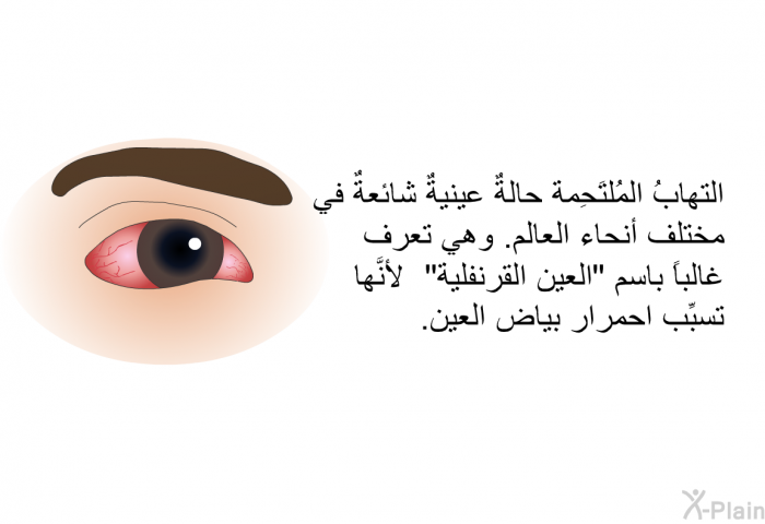 التهابُ المُلتَحِمة حالةٌ عينيةٌ شائعةٌ في مختلف أنحاء العالم. وهي تعرف غالباً باسم "العين القرنفلية"، لأنَّها تسبِّب احمرار بياض العين.