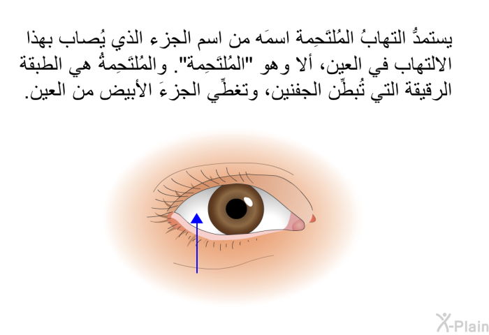 يستمدُّ التهابُ المُلتَحِمة اسمَه من اسم الجزء الذي يُصاب بهذا الالتهاب في العين، ألا وهو "المُلتَحِمة". والمُلتَحِمةُ هي الطبقة الرقيقة التي تُبطِّن الجفنين، وتغطِّي الجزءَ الأبيض من العين.
