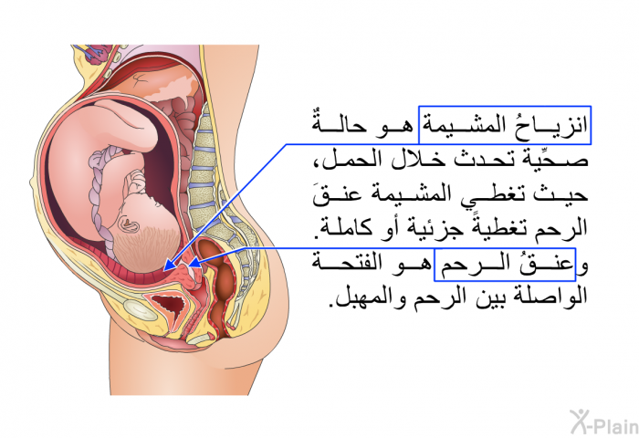 انزياحُ المشيمة هو حالةٌ صحِّية تحدث خلال الحمل، حيث تغطي المشيمة عنقَ الرحم تغطيةً جزئية أو كاملة. وعنقُ الرحم هو الفتحة الواصلة بين الرحم والمهبل.