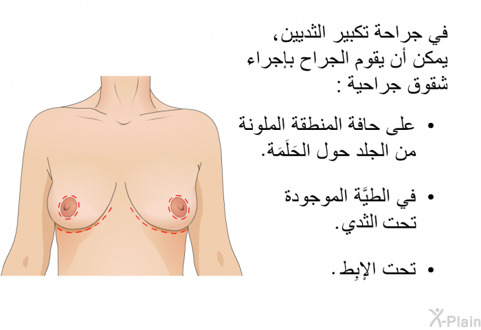 في جراحة تكبير الثديين، يمكن أن يقوم الجراح بإجراء شقوق جراحية:  على حافة المنطقة الملونة من الجلد حول الحَلَمَة. في الطَّيَّة الموجودة تحت الثدي. تحت الإبِط.