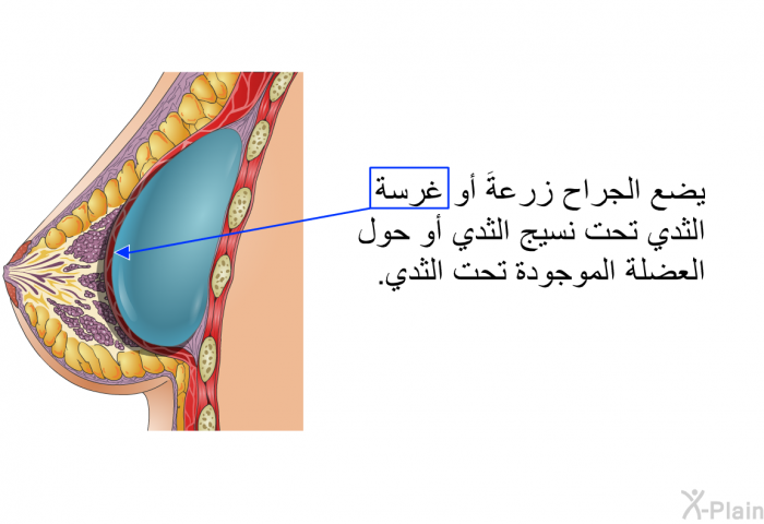 يضع الجراح زرعةَ أو غرسة الثدي تحت نسيج الثدي أو حول العضلة الموجودة تحت الثدي.