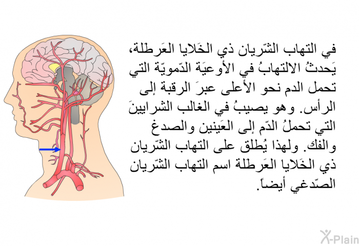 في التهاب الشّريان ذي الخَلايا العَرطَلة، يَحدثُ الالتهابُ في الأوعيَة الدّمويّة التي تحمل الدم نحو الأعلى عبرَ الرقبة إلى الرأس. وهو يصيبُ في الغالب الشرايينَ التي تحملُ الدّم إلى العَينين والصدغ والفك. ولهذا يُطلق على التهاب الشّريان ذي الخَلايا العَرطَلة اسم التهاب الشّريان الصّدغي أيضاً.