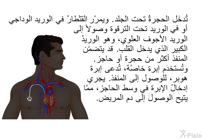 تُدخَل الحجرةُ تحت الجلد. ويمرَّر القثطارُ في الوريد الوداجي أو في الوريد تحت الترقوة وصولاً إلى الوريد الأجوف العلوي، وهو الوريدُ الكبير الذي يدخل القلب. قد يتضمَّن المنفذ أكثر من حجرة أو حاجز. وتُستخدَم إبرةٌ خاصَّة، تُدعى إبرة هوبر، للوصول إلى المنفذ. يجري إدخالُ الإبرة في وسط الحاجز، ممَّا يتيح الوصولَ إلى دم المريض.