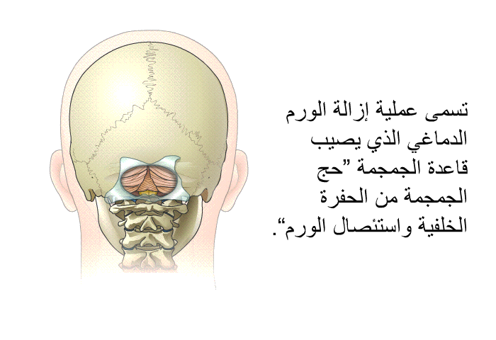 تسمى عملية إزالة الورم الدماغي الذي يصيب قاعدة الجمجمة <B>"</B>حج الجمجمة من الحفرة الخلفية واستئصال الورم<B>"</B>