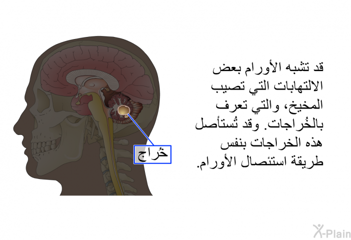 قد تشبه الأورام بعض الالتهابات التي تصيب المخيخ، والتي تعرف بالخُراجات<B>. </B>وقد تُستأصل هذه الخراجات بنفس طريقة استئصال الأورام<B>.</B>