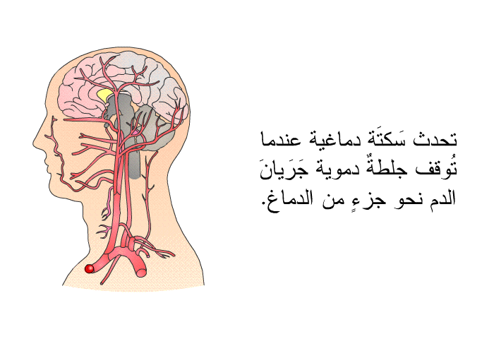 تحدث سَكتَة دماغية عندما تُوقف جلطةٌ دموية جَرَيانَ الدم نحو جزءٍ من الدماغ.