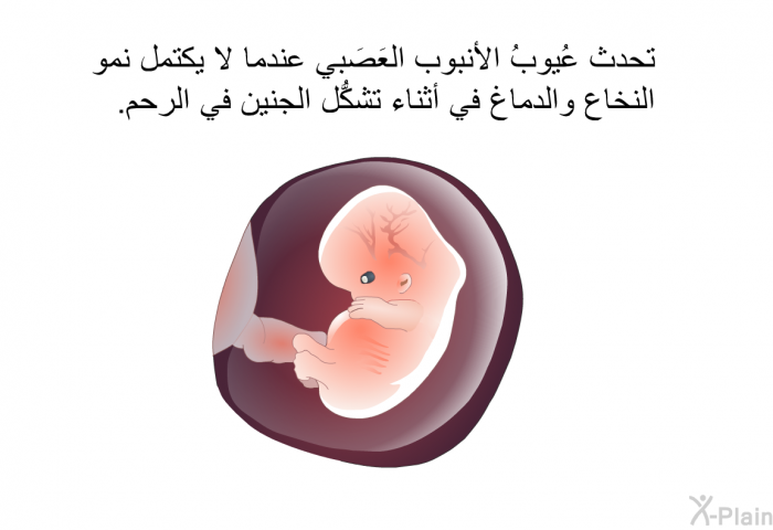 تحدث عُيوبُ الأنبوب العَصَبي عندما لا يكتمل نمو النخاع والدماغ في أثناء تشكُّل الجنين في الرحم.