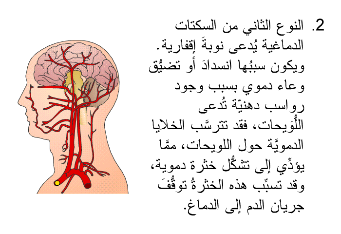 نوع من السكتات الدماغية يُدعى نوبةَ إقفارية. ويكون سببُها انسدادَ أو تضيُّق وعاء دموي بسبب وجود رواسب دهنيّة تُدعى اللُّوَيحات، فقد تترسَّب الخلايا الدمويَّة حول اللويحات، ممَّا يؤدِّي إلى تشكُّل خثرة دموية، وقد تسبِّب هذه الخثرةُ توقُّفَ جريان الدم إلى الدماغ.