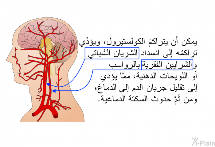 يمكن أن يتراكمَ الكولستيرول، ويؤدِّي تراكمُه إلى انسداد الشريان السُّباتي والشرايين الفقرية بالرواسب أو اللويحات الدهنية، ممَّا يؤدي إلى تقليل جريان الدم إلى الدماغ، ومن ثَمَّ حدوث السكتة الدماغية<I>.</I>