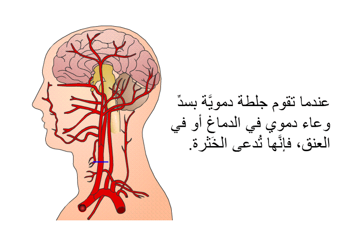 عندما تقوم جلطةٌ دمويَّة بسدِّ وعاء دموي في الدماغ أو في العنق، فإنَّها تُدعى الخَثرة<I>.</I>