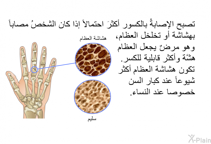 تصبح الإصابةُ بالكسور أكثرَ احتمالاً إذا كان الشخصُ مصاباً بهشاشة أو تخلخل العظام، وهو مرضٌ يجعل العظام هشَّة وأكثر قابلية للكسر. تكون هشاشة العظام أكثر شيوعاً عند كبار السن خصوصاً عند النساء.