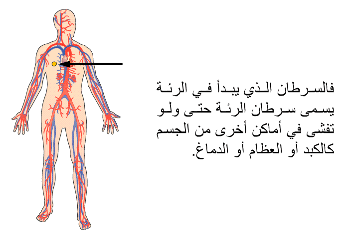 فالسرطان الذي يبدأ في الرئة يسمى سرطان الرئة حتى ولو تفشى في أماكن أخرى من الجسم كالكبد أو العظام أو الدماغ.