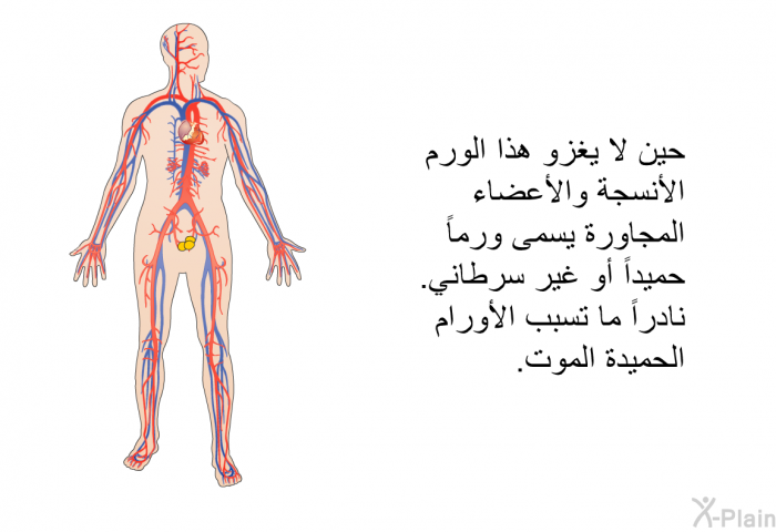 حين لا يغزو هذا الورم الأنسجة والأعضاء المجاورة يسمى ورماً حميداً أو غير سرطاني. نادراً ما تسبب الأورام الحميدة الموت.