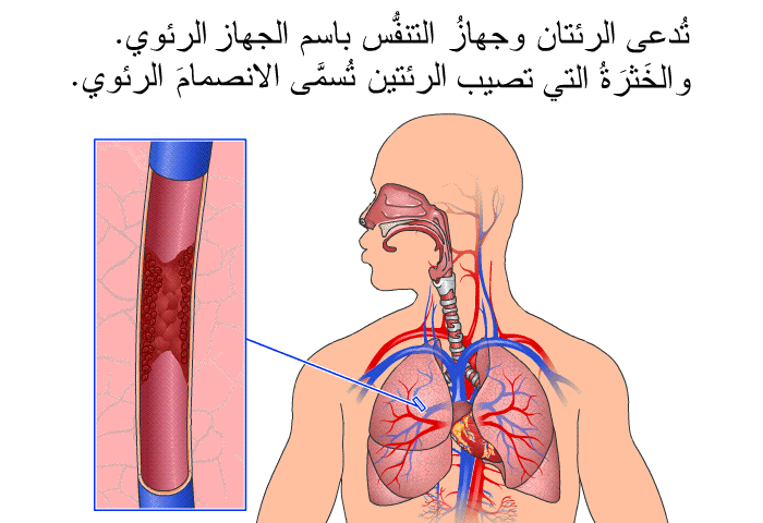 تُدعى الرئتان وجهازُ التنفُّس باسم الجهاز الرئوي. والخَثرَةُ التي تصيب الرئتين تُسمَّى الانصمامَ الرئوي.