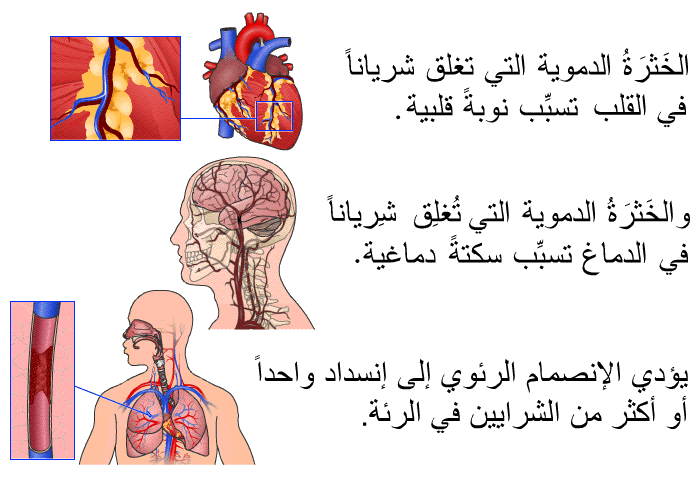 الخَثرَةُ الدموية التي تغلق شرياناً في القلب تسبِّب نوبةً قلبية، والخَثرَةُ الدموية التي تُغلِق شِرياناً في الدماغ تسبِّب سكتةً دماغية. يؤدي الإنصمام الرئوي إلى إنسداد واحداً أو أكثر من الشرايين في الرئة.