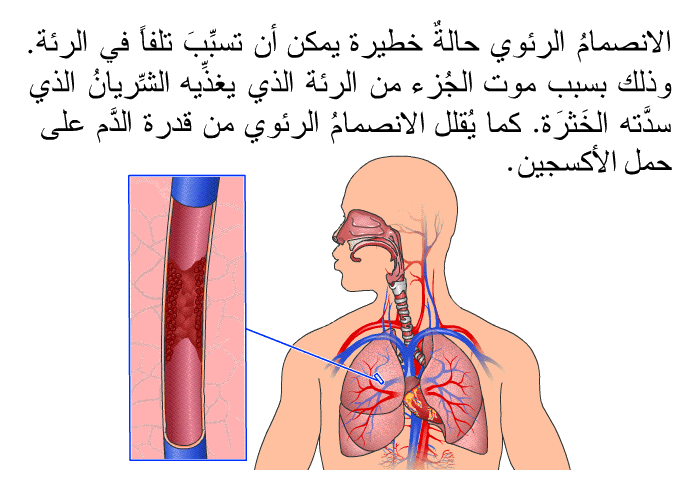 الانصمامُ الرئوي حالةٌ خطيرة يمكن أن تسبِّبَ تلفاً في الرئة.وذلك بسبب موتَ الجُزء من الرئة الذي يغذِّيه الشِّريانُ الذي سدَّته الخَثرَة. كما يُقلِّل الانصمامُ الرئوي من قدرة الدَّم على حمل الأكسجين.
