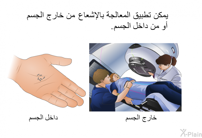يمكن تطبيق المعالجة بالإشعاع من خارج الجسم أو من داخل الجسم.