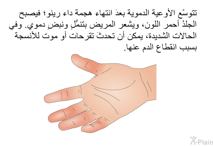 تتوسَّع الأوعيةُ الدموية بعدَ انتهاء هجمة داء رينو؛ فيصبح الجلدُ أحمر اللون، ويشعر المريض بتنمُّلٍ ونبضٍ دموي. وفي الحالات الشديدة، يمكن أن تحدثَ تقرحات أو موت للأنسجة بسبب انقطاع الدم عنها.