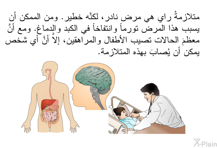 متلازمةُ راي هي مرض نادر، لكنَّه خطير. ومن الممكن أن يسبب هذا المرض تورماً وانتفاخاً في الكبد والدماغ. ومع أنَّ معظمَ الحالات تصيب الأطفال والمراهقين، إلاَّ أنَّ أي شخص يمكن أن يُصابَ بهذه المتلازمة.