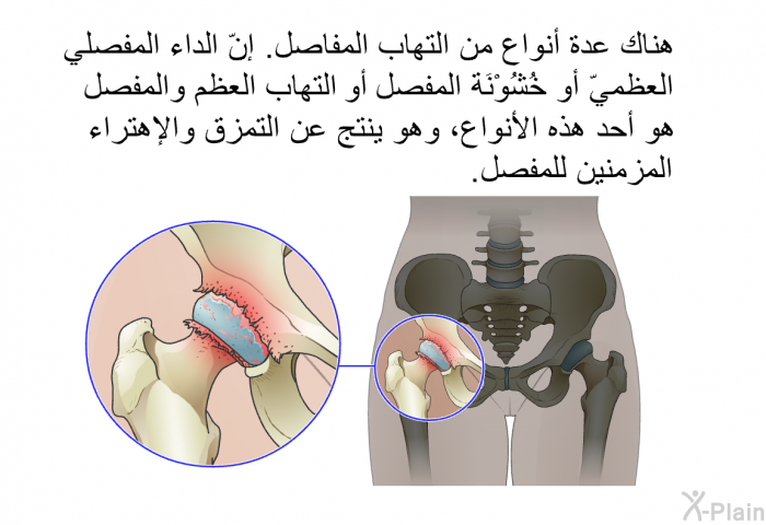 هناك عدة أنواعٍ من التهاب المفاصل. إنّ الداء المفصلي العظميّ أو خُشُوْنَةُ المفصل أو التهاب العظم والمفصل هو أحد هذه الأنواع، وهو ينتج عن التمزق والإهتراء المزمنين للمفصل.