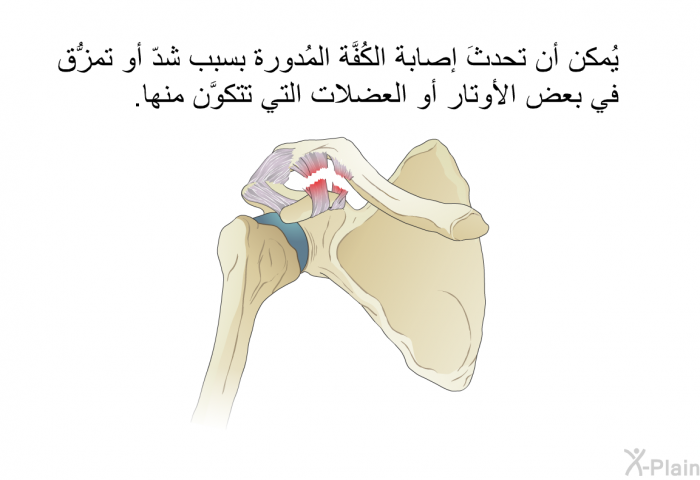 يُمكن أن تحدثَ إصابة الكُفّة المُدوَّرة بسبب شدّ أو تمزُّق في بعض الأوتار أو العضلات التي تتكوَّن منها‎<B>. </B>