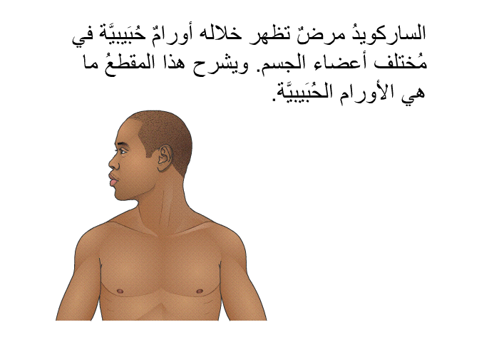 الساركويدُ مرضٌ تظهر خلاله أورامٌ حُبَيبيَّة في مُختلف أعضاء الجسم. ويشرح هذا المقطعُ ما هي الأورام الحُبَيبيَّة.