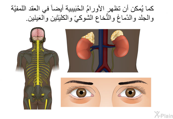 كما يُمكن أن تظهر الأورامُ الحُبَيبية أيضاً في العقد اللمفيَّة والجلد والدِّماغ والنُّخاع الشوكيِّ والكليَتَين والعَينَين.