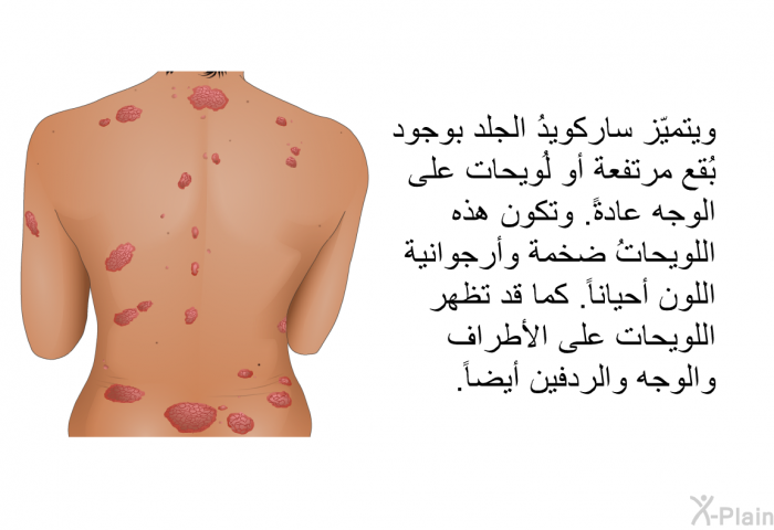 ويتميّز ساركويدُ الجلد بوجود بُقع مرتفعة أو لُويحات على الوجه عادةً. وتكون هذه اللويحاتُ ضخمة وأرجوانية اللون أحياناً. كما قد تظهر اللويحات على الأطراف والوجه والردفين أيضاً.