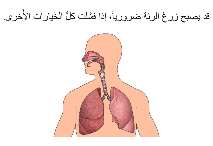 قد يصبح زرعُ الرئة ضرورياً، إذا فشلت كلُّ الخَيارات الأُخرى.