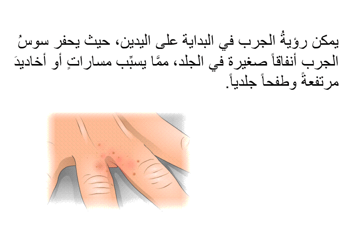 يمكن رؤيةُ الجرب في البداية على اليدين، حيث يحفر سوسُ الجرب أنفاقاً صغيرة في الجلد، ممَّا يسبِّب مساراتٍ أو أخاديدَ مرتفعةً وطفحاً جلدياً.