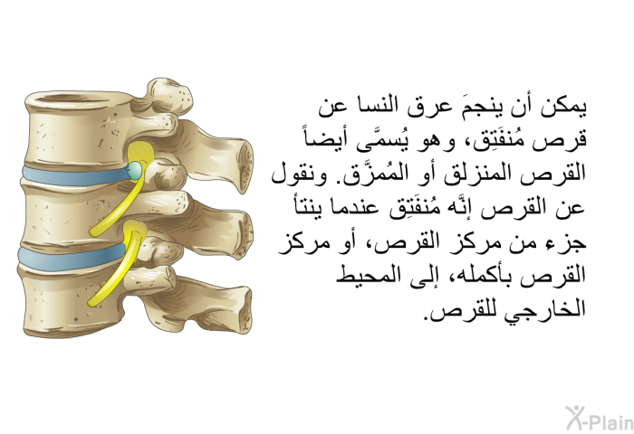 يمكن أن ينجمَ عرق النسا عن قرص مُنفَتِق، وهو يُسمَّى أيضاً القرص المنزلق أو المُمزَّق. ونقول عن القرص إنَّه مُنفَتِق عندما ينتأ جزءٌ من مركز القرص، أو مركز القرص بأكمله، إلى المحيط الخارجي للقرص.