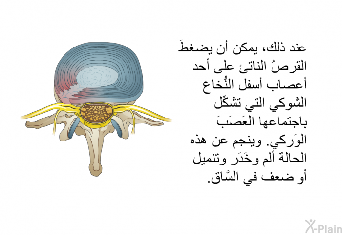 عند ذلك، يمكن أن يضغطَ القرصُ الناتئ على أحد أعصاب أسفل النُّخاع الشوكي التي تشكِّل باجتماعها العَصَبَ الوَركي. وينجم عن هذه الحالة ألمٌ وخَدَر وتنميل أو ضعف في السَّاق.