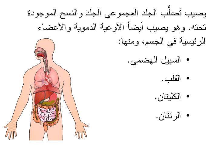 يصيب تَصَلُّب الجلد المجموعي الجلدَ والنسج الموجودة تحته. وهو يصيب أيضاً الأوعية الدموية والأعضاء الرئيسية في الجسم، ومنها:   السبيل الهضمي.  القلب.  الكليتان.  الرئتان.