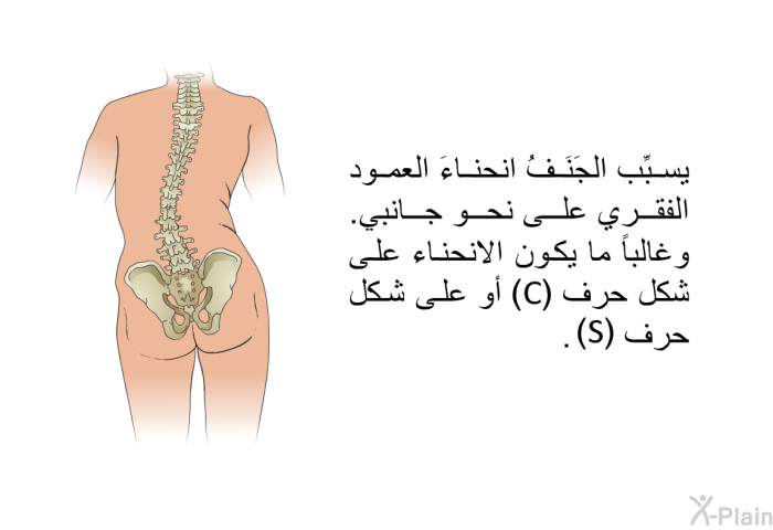 يسبِّب الجَنَفُ انحناءَ العمود الفقري على نحو جانبي. وغالباً ما يكون الانحناء على شكل حرف (C) أو على شكل حرف (S).