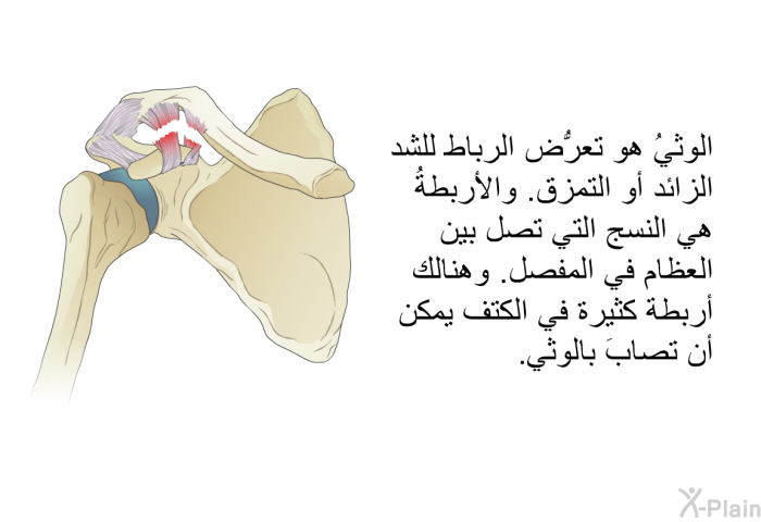 الوثيُ هو تعرُّض الرباط للشد الزائد أو التمزق. والأربطةُ هي النسج التي تصل بين العظام في المفصل. وهنالك أربطة كثيرة في الكتف يمكن أن تصابَ بالوثي.