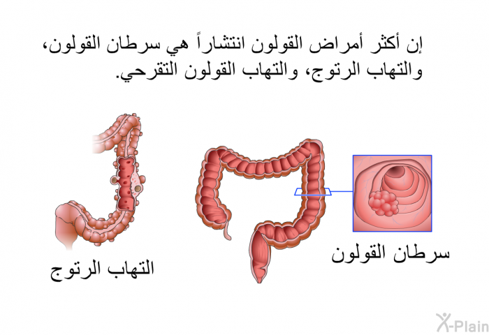 إن أكثر أمراض القولون انتشاراً هي سرطان القولون، والتهاب الرتوج، والتهاب القولون التقرحي.