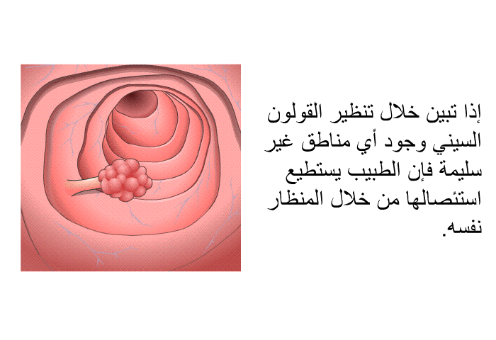 إذا تبين خلال تنظير القولون السيني وجود أي مناطق غير سليمة فإن الطبيب يستطيع استئصالها من خلال المنظار نفسه.