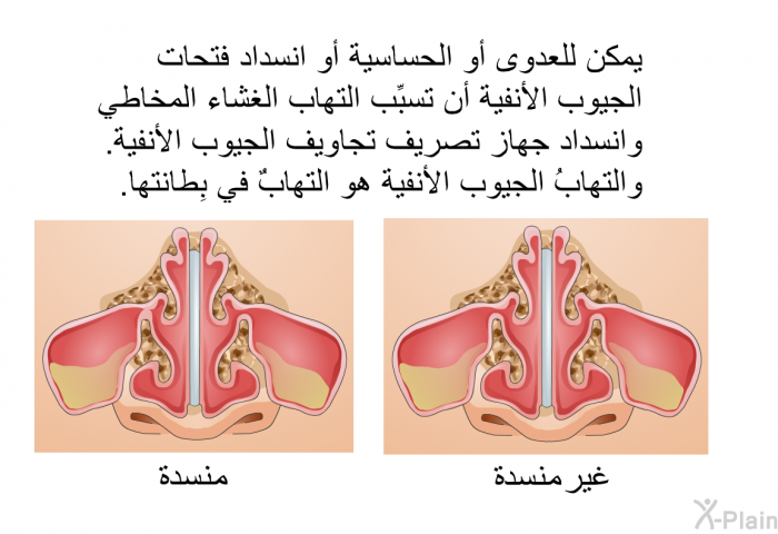 يمكن للعدوى أو الحساسية أو انسداد فتحات الجيوب الأنفية أن تسبِّب التهاب الغشاء المخاطي وانسداد جهاز تصريف تجاويف الجيوب الأنفية. والتهابُ الجيوب الأنفية هو التهابٌ في بِطانتها.