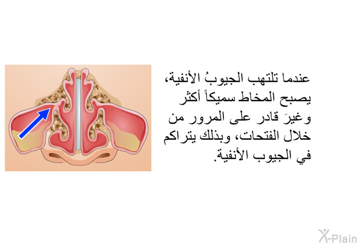 عندما تلتهب الجيوبُ الأنفية، يصبح المخاط سميكاً أكثر وغيرَ قادر على المرور من خلال الفتحات، وبذلك يتراكم في الجيوب الأنفية.