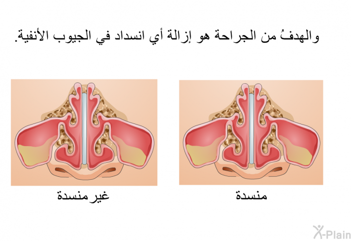 والهدفُ من الجراحة هو إزالة أي انسداد في الجيوب الأنفية.
